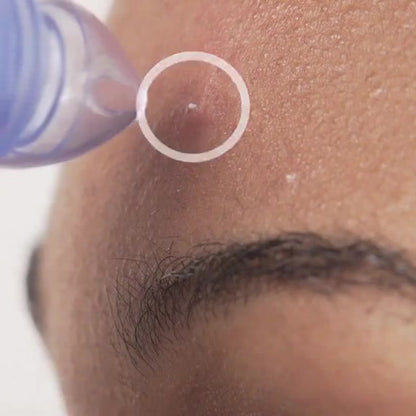 ASPIRATEUR POINTS NOIRS | NettoSkin™