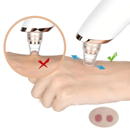 AspiNet™ | ASPIRATEUR ÉLECTRIQUE DE POINTS NOIRS & PORES - Allure de Charme